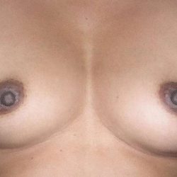 Breast Augmentation Before & After Patient #2213
