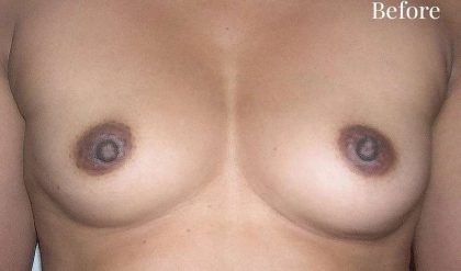 Breast Augmentation Before & After Patient #2213