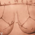 Breast Lift Before & After Patient #2294