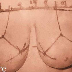 Breast Lift Before & After Patient #2294