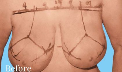 Breast Lift Before & After Patient #2294