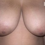 Breast Reduction Before & After Patient #2323
