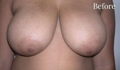 Breast Reduction Before & After Patient #2323