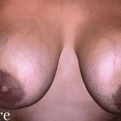 Breast Revision Before & After Patient #2369