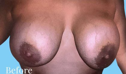 Breast Revision Before & After Patient #2369