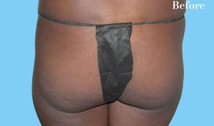 Buttock Augmentation Before & After Patient #2402