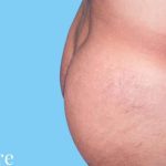 Buttock Augmentation Male Before & After Patient #2468