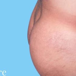 Buttock Augmentation Male Before & After Patient #2468