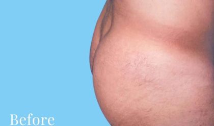 Buttock Augmentation Male Before & After Patient #2468
