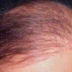 Hair Restoration Before & After Patient #2769