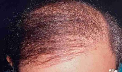 Hair Restoration Before & After Patient #2769