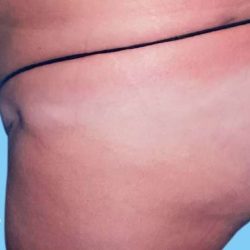 Buttock Augmentation Before & After Patient #2417