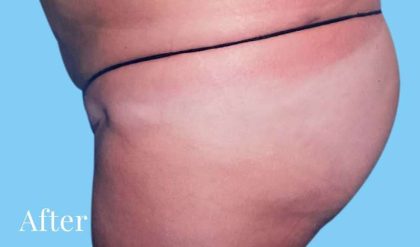Buttock Augmentation Before & After Patient #2417