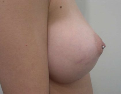 Breast Augmentation Before & After Patient #2227