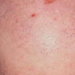 Hair Restoration Before & After Patient #2769