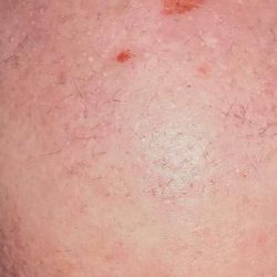 Hair Restoration Before & After Patient #2769
