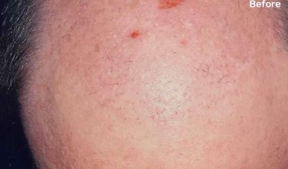 Hair Restoration Before & After Patient #2769
