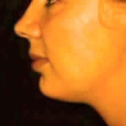 Liposuction Before & After Patient #2847