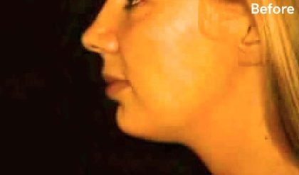 Liposuction Before & After Patient #2847