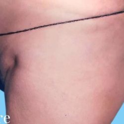 Buttock Augmentation Before & After Patient #2417
