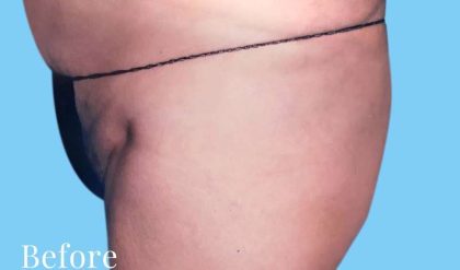 Buttock Augmentation Before & After Patient #2417