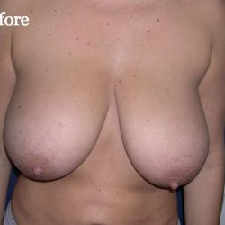 Breast Reduction Before & After Patient #2337