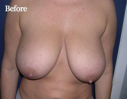 Breast Reduction Before & After Patient #2337