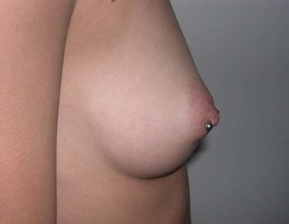 Breast Augmentation Before & After Patient #2227