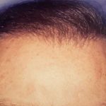 Hair Restoration Before & After Patient #2793
