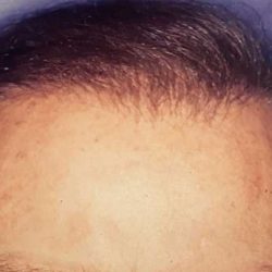 Hair Restoration Before & After Patient #2793