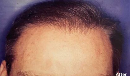 Hair Restoration Before & After Patient #2793