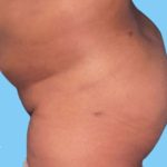 Buttock Augmentation Before & After Patient #2450