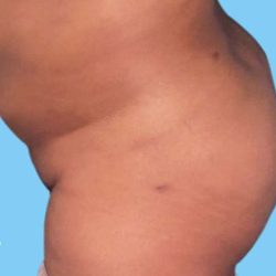 Buttock Augmentation Before & After Patient #2450