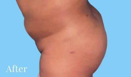 Buttock Augmentation Before & After Patient #2450