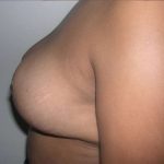 Breast Reduction Before & After Patient #2354