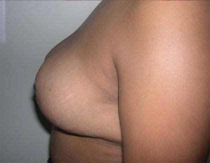 Breast Reduction Before & After Patient #2354