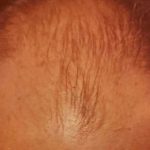 Hair Restoration Before & After Patient #2793