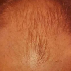 Hair Restoration Before & After Patient #2793