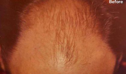 Hair Restoration Before & After Patient #2793