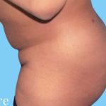 Buttock Augmentation Before & After Patient #2450