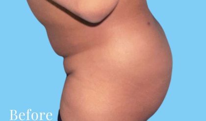 Buttock Augmentation Before & After Patient #2450