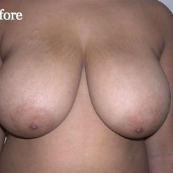 Breast Reduction Before & After Patient #2354