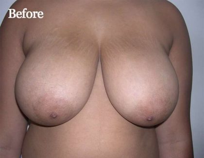 Breast Reduction Before & After Patient #2354