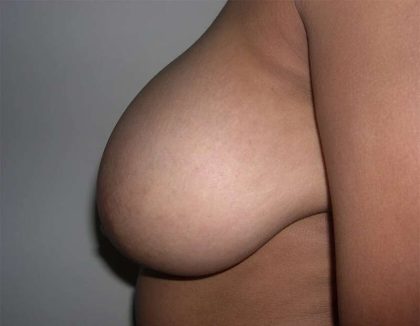 Breast Reduction Before & After Patient #2354