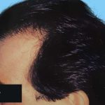 Hair Restoration Before & After Patient #2746