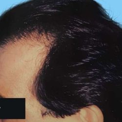 Hair Restoration Before & After Patient #2746