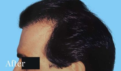 Hair Restoration Before & After Patient #2746
