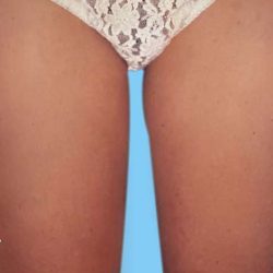 Liposuction Before & After Patient #2826