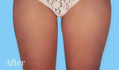 Liposuction Before & After Patient #2826