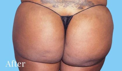Buttock Augmentation Before & After Patient #2390